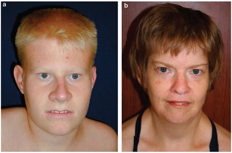 prada williams syndrome|prader willi syndrome in children.